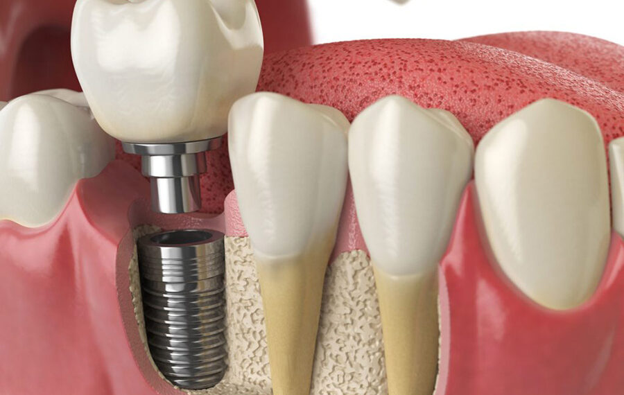 dental implants near me